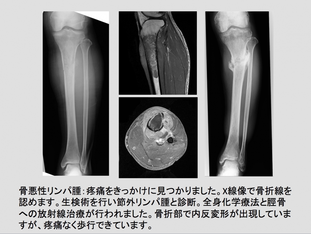 骨軟部腫瘍 | がんセンター | 立川病院