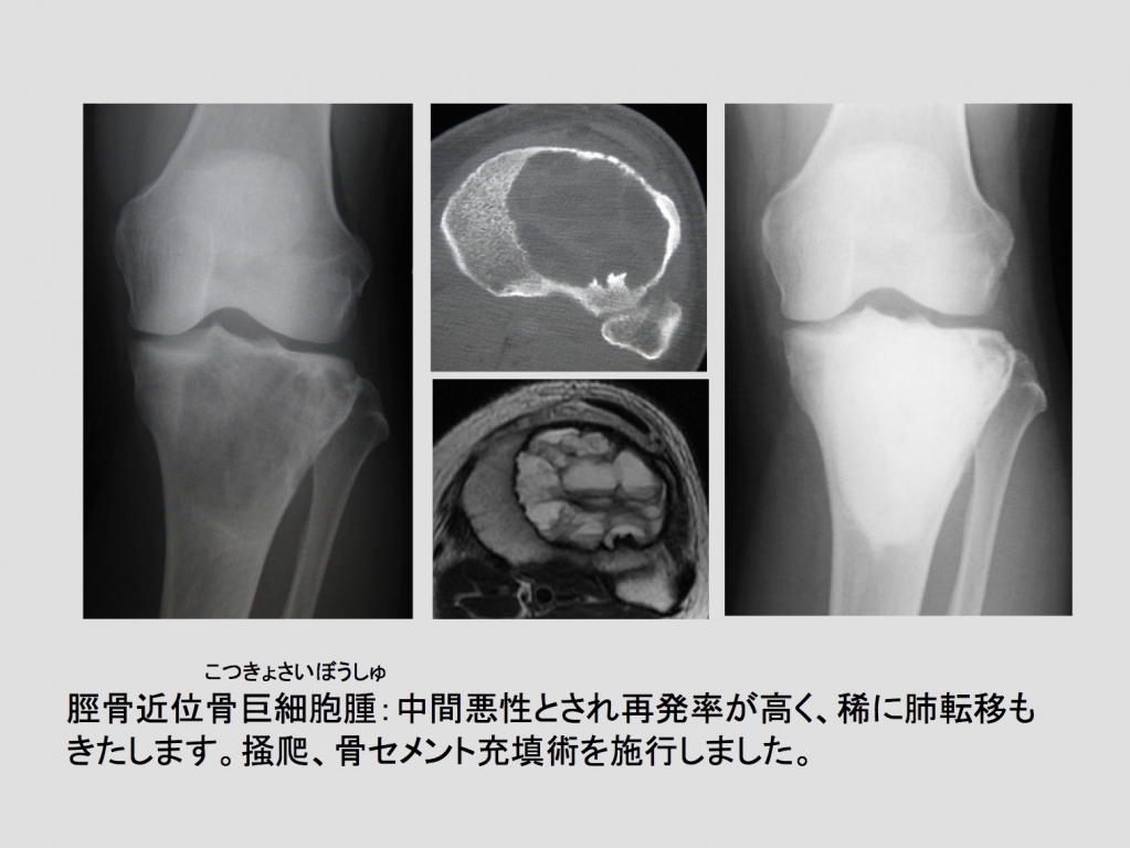 骨軟部腫瘍 | がんセンター | 立川病院