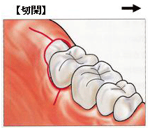 親知らず（智歯）の抜歯 | 疾患解説 | 立川病院