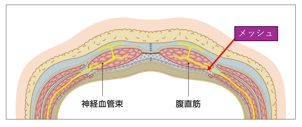 腹壁瘢痕ヘルニア1.png