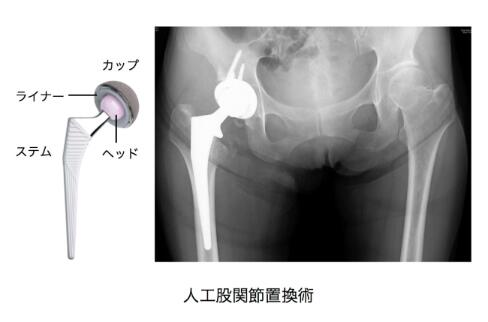 股関節痛からの解放 ― 人工股関節置換術 | 健康コラム | 立川病院