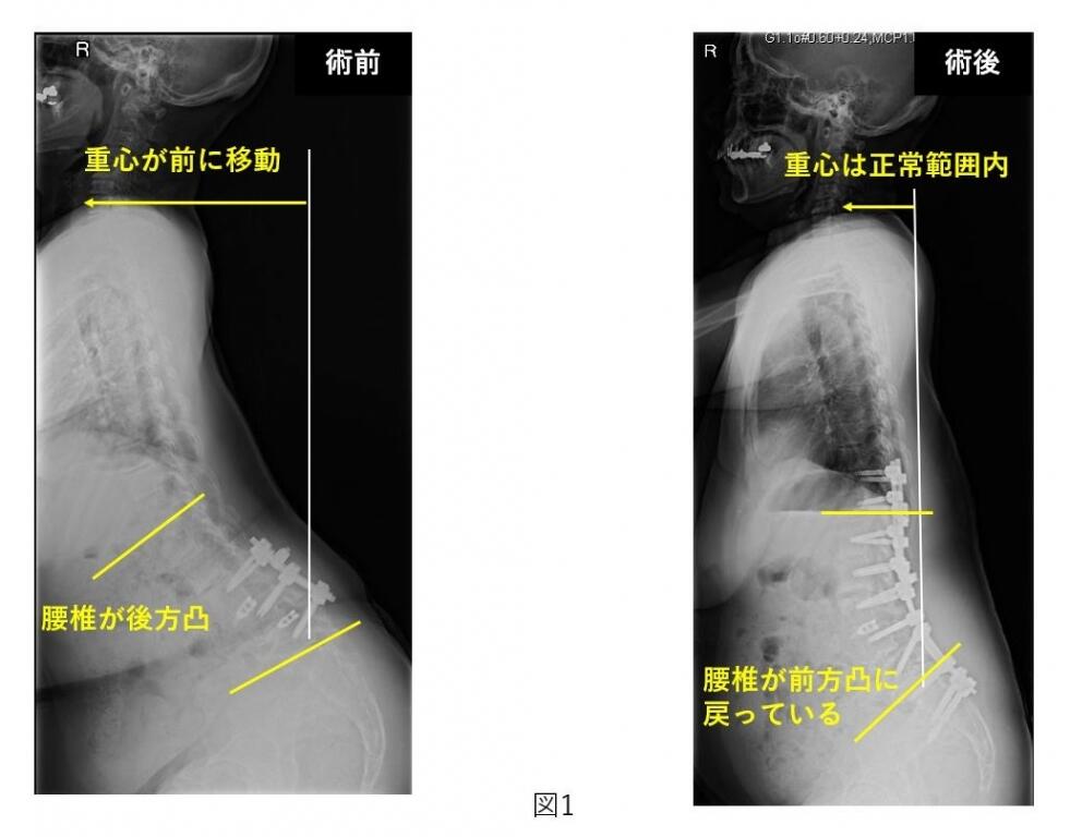 脊柱変形 (側弯症と首下がり症) | 疾患解説 | 立川病院